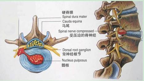 椎间盘的恢复,椎间盘恢复生理曲度方法
