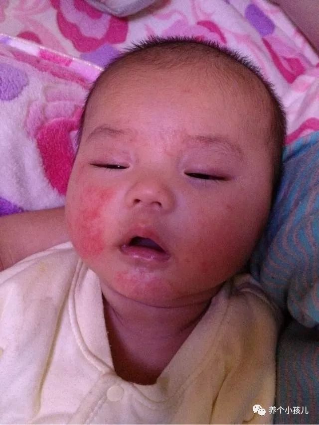 宝宝出现湿疹的原因和护理措施,高烧湿疹的症状及治疗方法