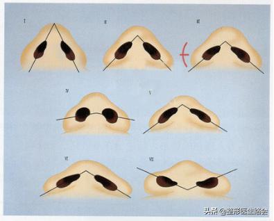 如何正确有效的缩小鼻翼,鼻翼大怎么缩小手术风险大吗