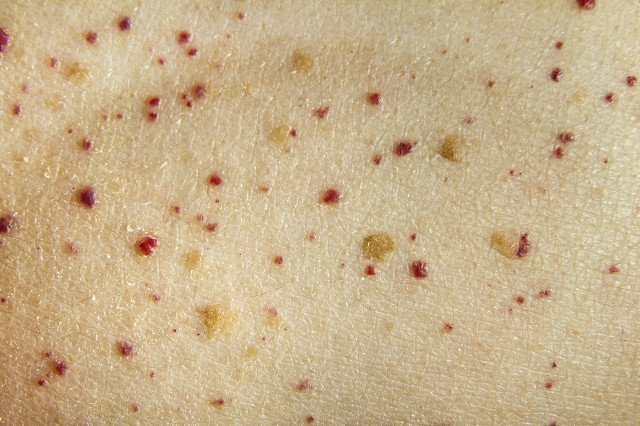 脸上怎么祛痣祛斑,脸上的痣怎么无痛祛痣