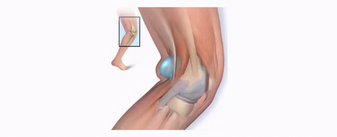 腘窝囊肿的原因与治疗,腘窝囊肿什么科