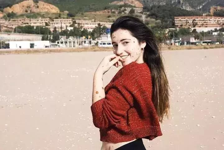 全身黑斑被骂“斑点狗”，身高160的她却成为最美超模…