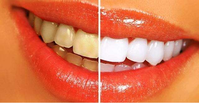 牙齿表面软软发臭的“黄泥”究竟是什么？教你三招，轻松去除