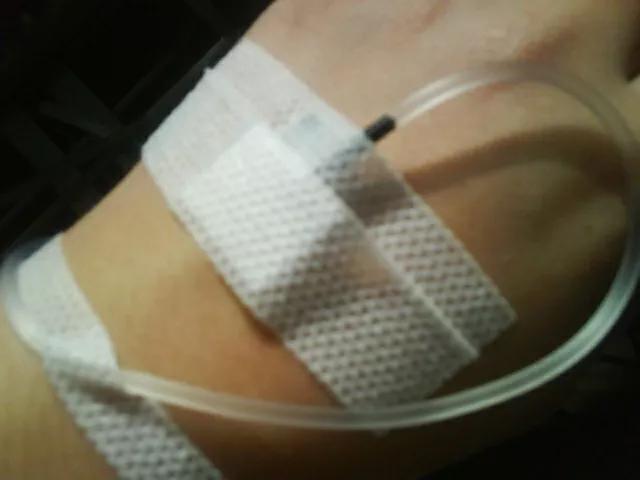 输液的手为什么会酸,输液的手一直青紫