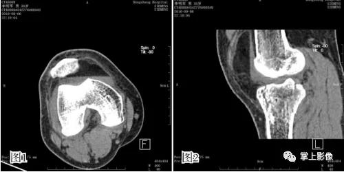 一种很少人知道的疾病,有哪些关节疾病