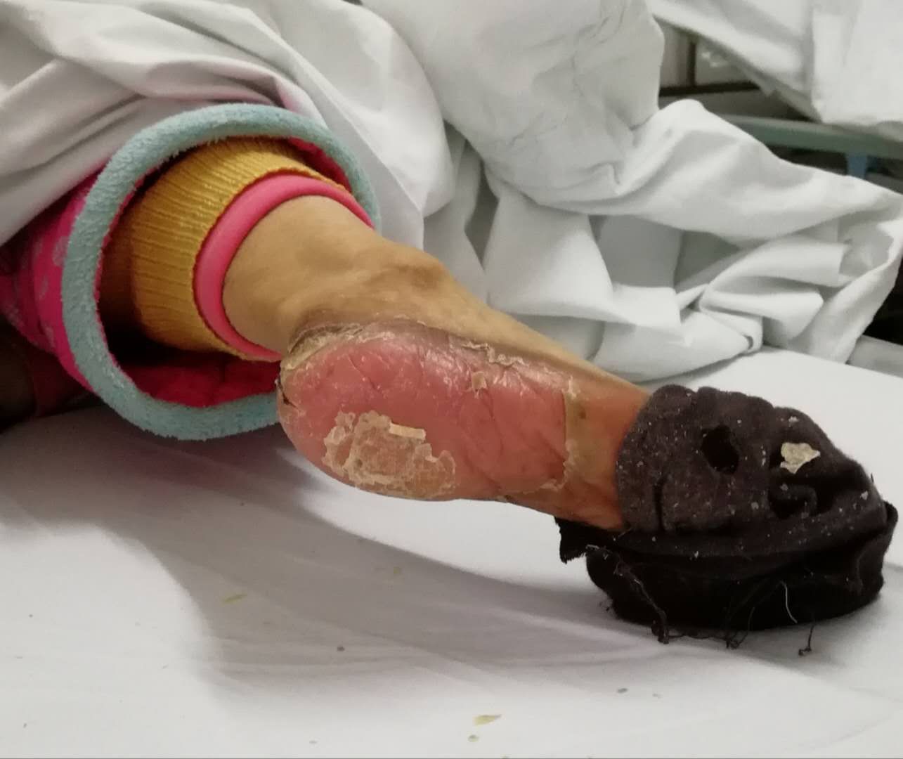 这个阿姨手脚破溃是怎么了？