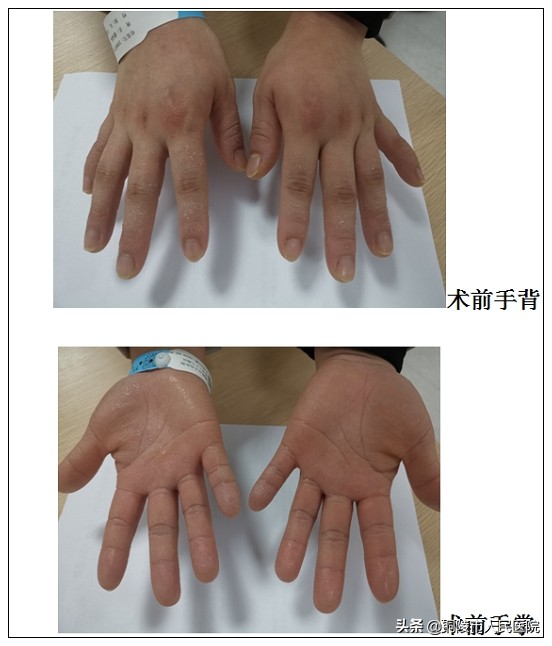 手心出汗是虚吗,手心出汗却不冰凉是怎么回事