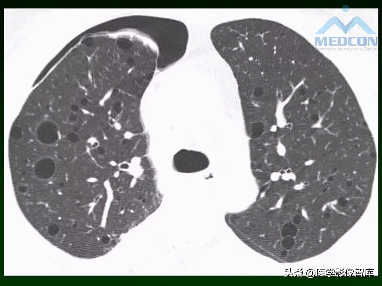 肺弥漫性网状影,两肺小叶间隔增厚可见网状模糊影