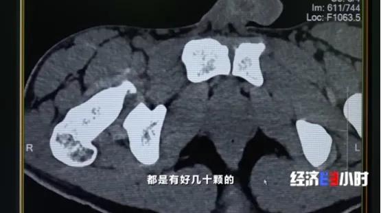 他被迫吞下72粒*洛因海**胶囊!突然,*品毒**破裂……