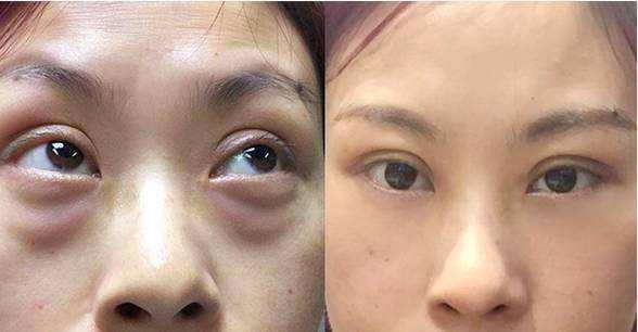 眼袋和卧蚕的区别教你区分小妙招,眼袋和卧蚕的区别在哪里