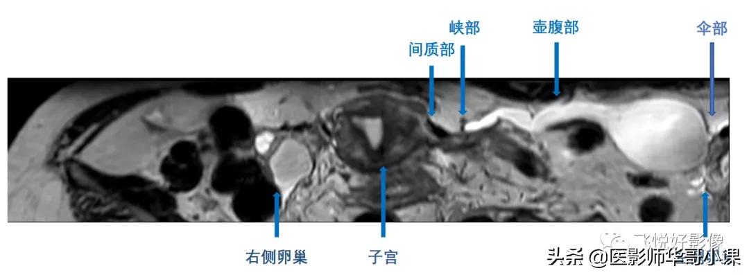 [飞利浦磁共振技术]磁共振扫描下的“女性输卵管成像”，看视频吧