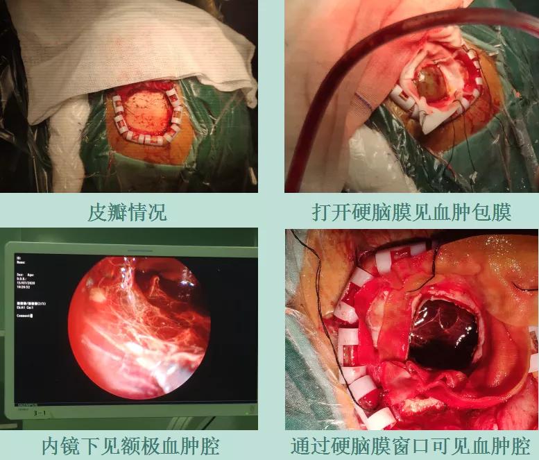 摔跤后有脑血肿怎么处理,轻微摔伤怎么处理
