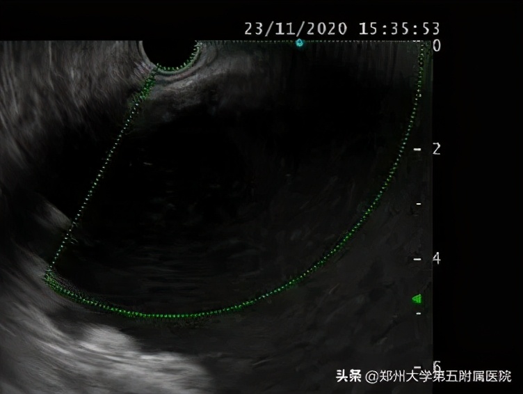 超声内镜下胰腺囊肿穿刺引流术,超声内镜下胰腺囊肿手术