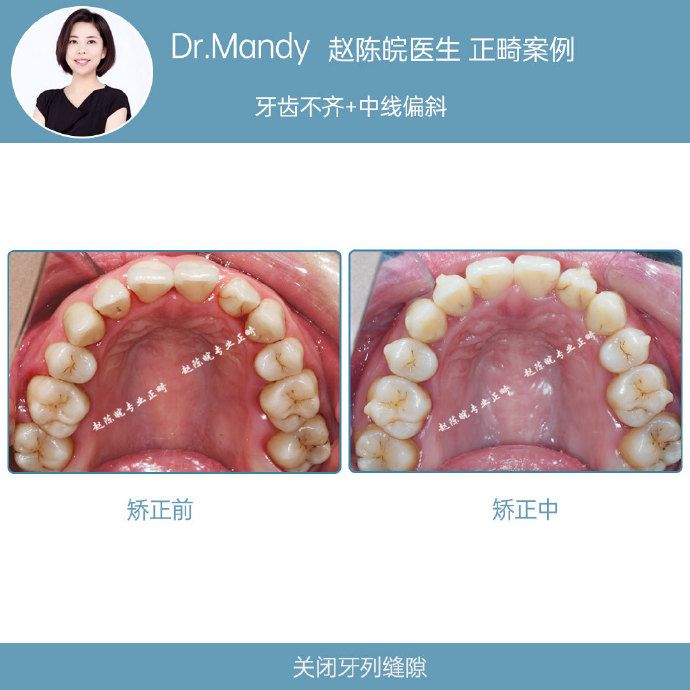 正畸牙齿不齐案例,牙齿拥挤正畸真实案例