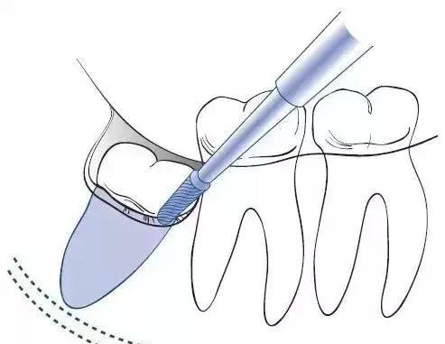 有一种痛叫智齿之痛,有种疼叫智齿