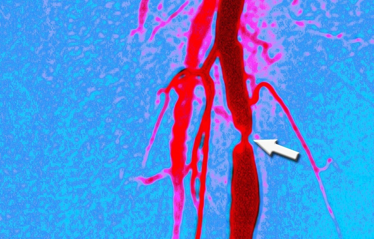 有高血压又有血管狭窄怎么办,高血压引起肾有问题看哪个科室