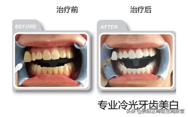 冷光美牙仪的危害,朋友圈冷光美牙仪