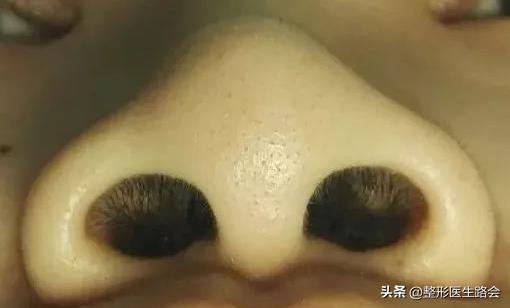鼻翼缩小会有什么影响,鼻翼缩小会不会影响鼻子呼吸