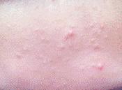 分享祛痘过程博主,分享自己治疗痘痘的经历