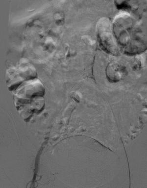 对造影剂过敏如何进行介入治疗,造影剂过敏迟发性治疗