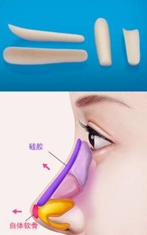 假体隆鼻能保持多久来了解一下,龚忠华整形