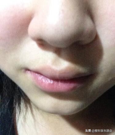 挤黑头鼻头大会变小,挤黑头鼻头会越来越大吗