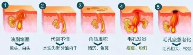 毛孔粗大抗炎,油脂性毛孔粗大怎么抗老