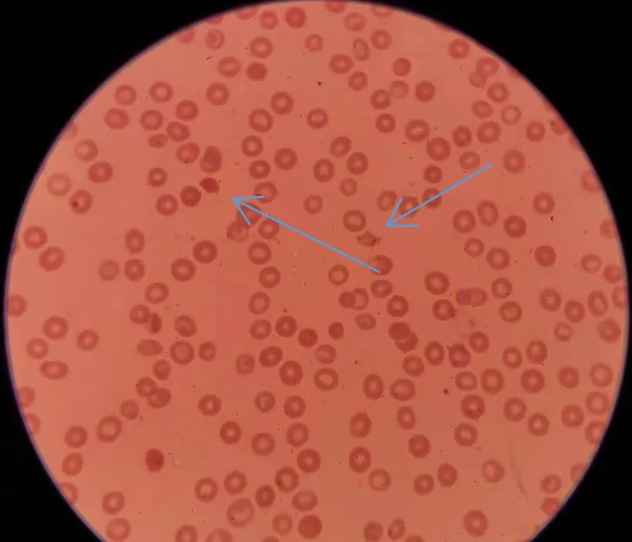 红细胞聚集指数偏高会引起血栓吗,红细胞分布宽度与血栓的关系