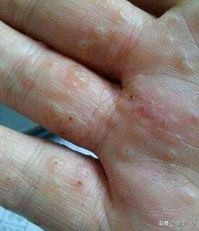 手脱皮考虑什么诊断,手脱皮有哪几种类型