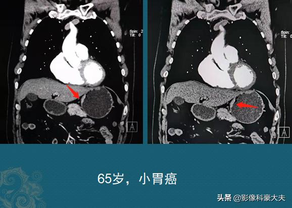 肺癌晚期胃癌,肺癌和胃癌晚期的状况