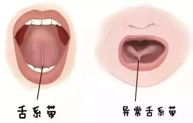 宝宝舌系带太短怎么办?3种治疗方法可选择