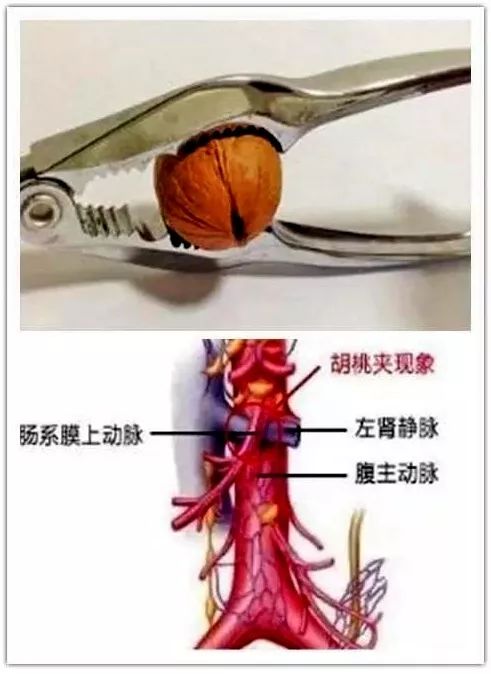 家长们担心的胡桃夹综合征是什么疾病