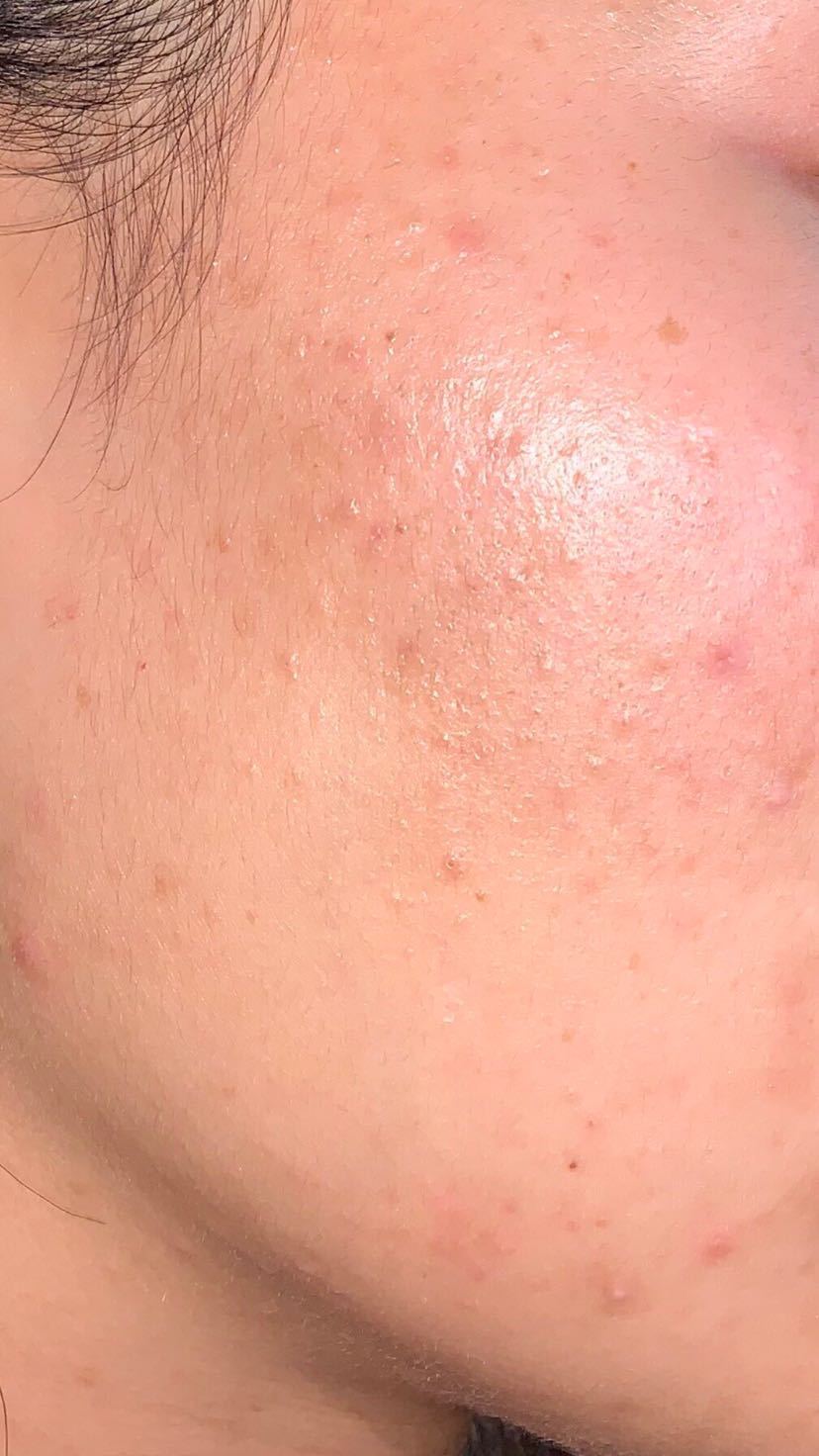 治疗疔疮最好的外用药,痔疮的外用药膏