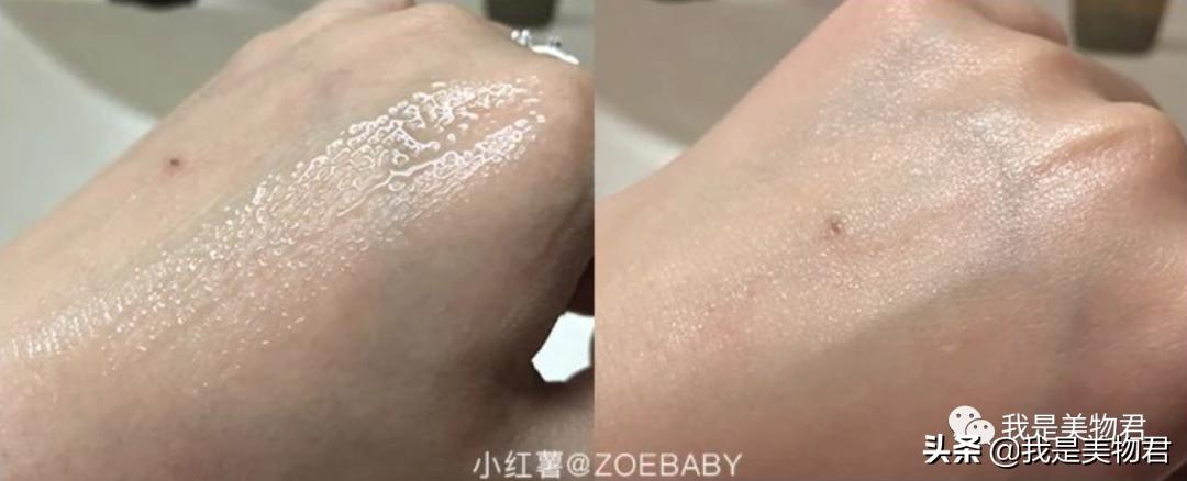 敏感肌最好的祛闭口神器,去闭口的最佳方法敏感肌