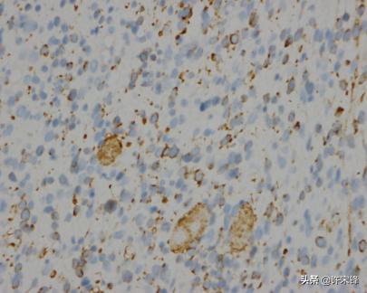 胚胎横纹肌肉瘤是怎么形成的,横纹肌肉瘤转移全身能活多久