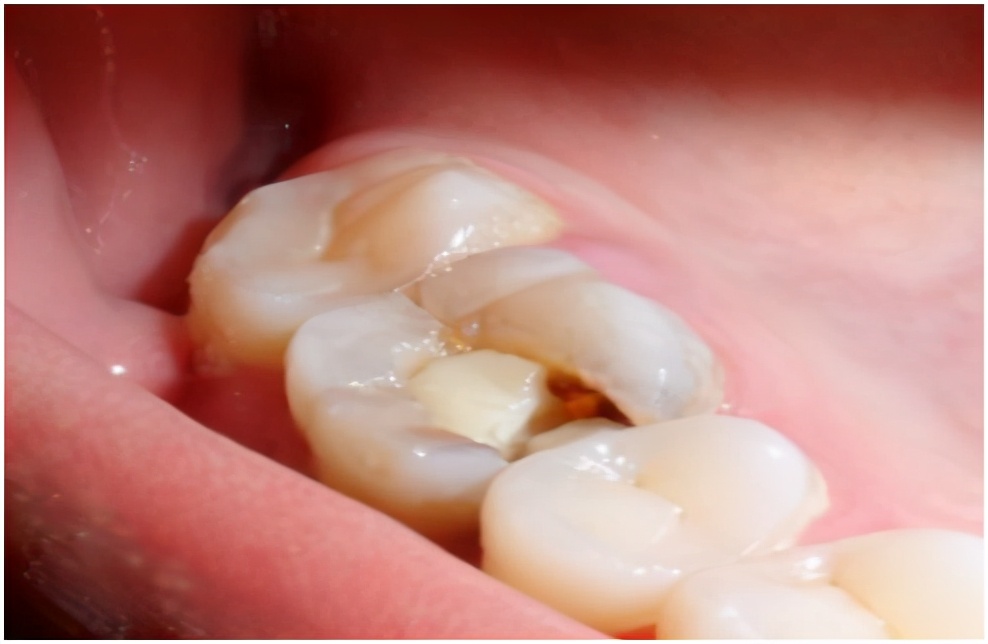 600块钱一颗牙怎么样,600块一颗牙贵吗