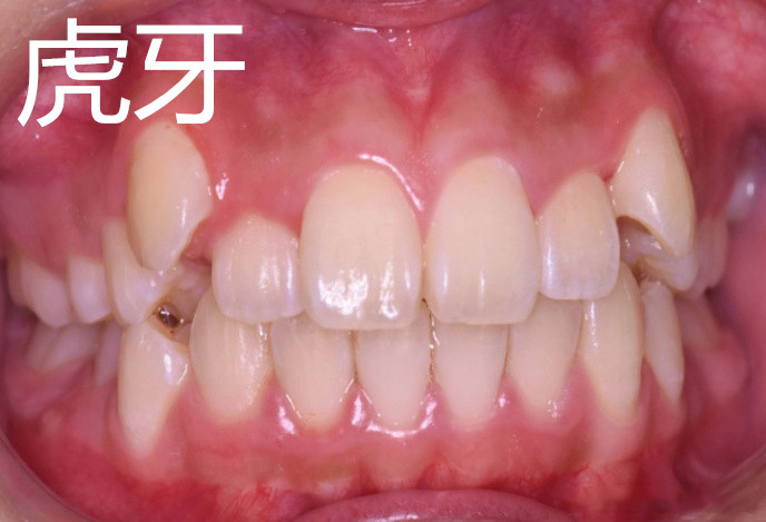 30岁还可以牙齿矫正吗,30岁牙齿矫正一般多少钱