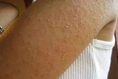小孩脸两侧鸡皮肤怎么消除最有效,后背鸡皮肤怎么消除最有效
