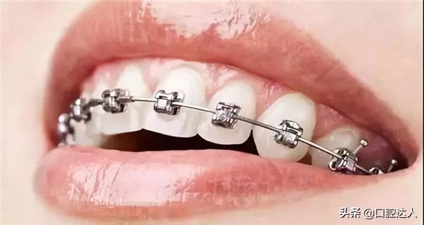 牙齿矫正步骤流程,牙齿矫正怎么操作