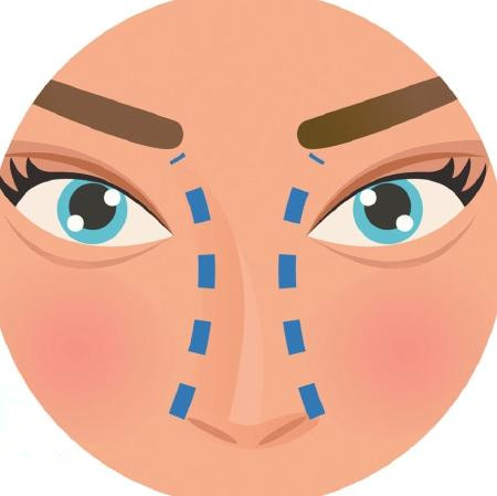 线雕隆鼻伤口一直流脓,线雕隆鼻鼻头针孔化脓