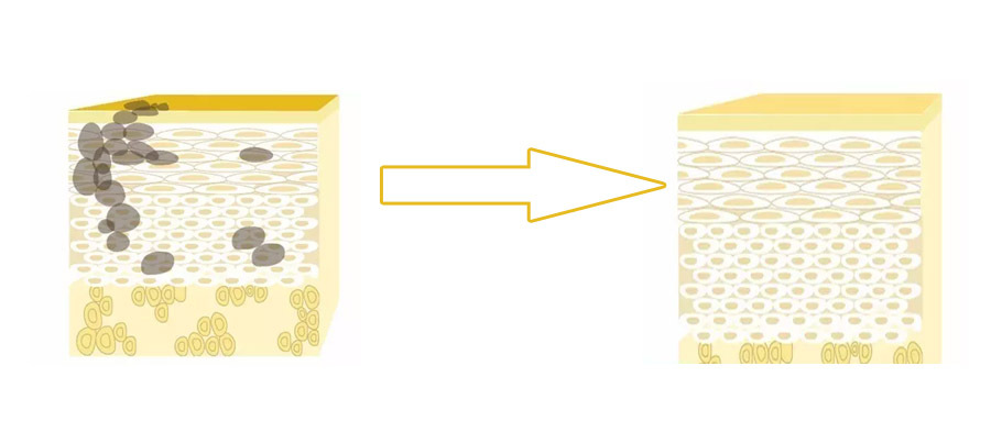 果酸换肤对哪种痘坑有效,果酸换肤对脂肪粒有效吗