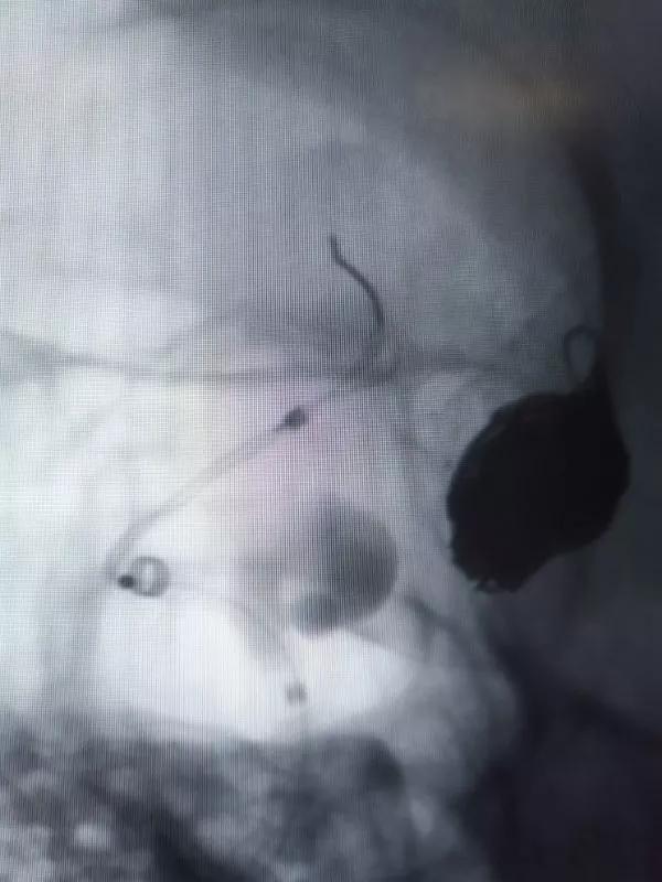 山东大学齐鲁医院王东海教授团队成功治疗多发性动脉瘤