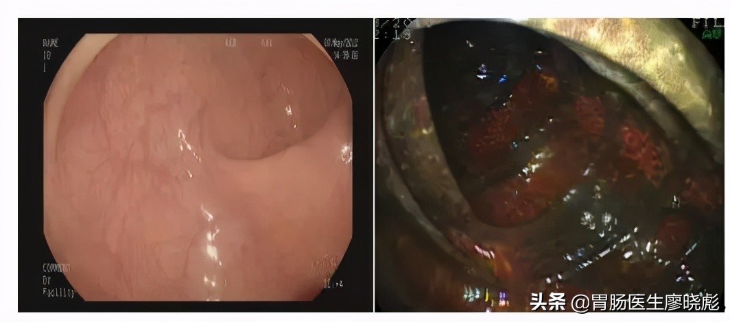 结肠黑变病介绍,为什么会患结肠黑变病