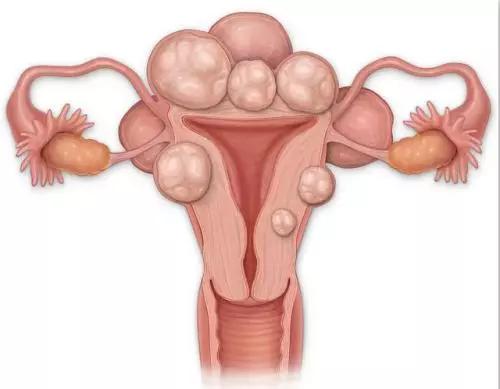 子宫肌瘤手术后对备孕有影响吗,子宫肌瘤患者怀孕了该怎么办