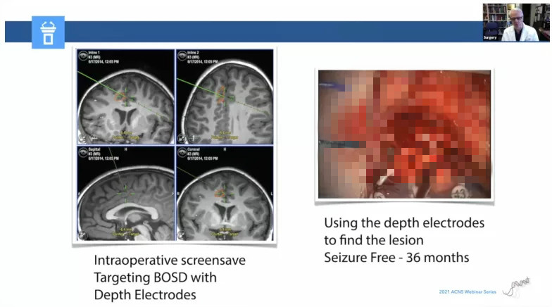 儿童癫痫治愈的真实案例,儿童难治性癫痫有哪些