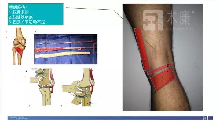 前叉术后两个月伤口处伸直会疼,前叉术后第11天的状态