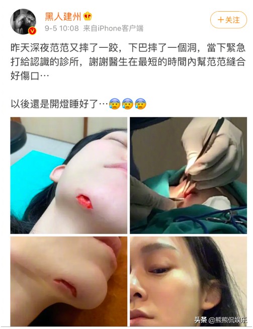 范玮琪不慎摔伤，下把六厘米伤口缝15针，伤口深可见骨