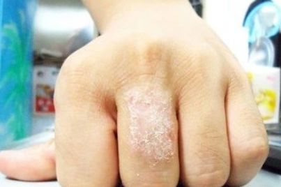 常见皮肤病的联合用药，呼吸道疾病的联合用药，值得收藏