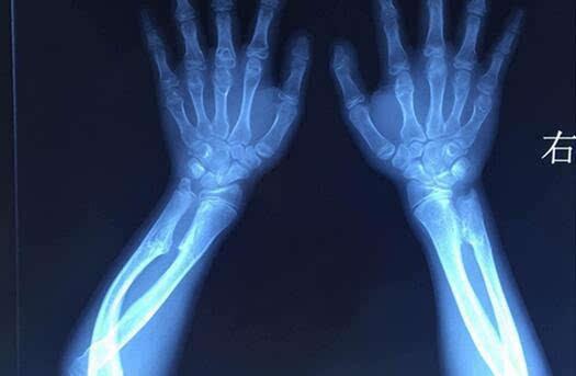 骨软骨瘤癌会遗传吗,骨软骨瘤怎么避免遗传给孩子