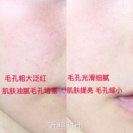 如何拯救毛孔粗大油腻的脸,毛孔粗大油皮救星